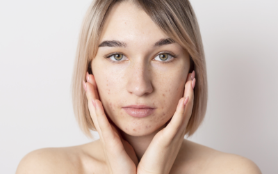 Acne: Cos’è e Come Sconfiggerla Senza Imbarazzo